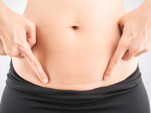Vết mổ sau sinh bao lâu thì lành và liền sẹo?