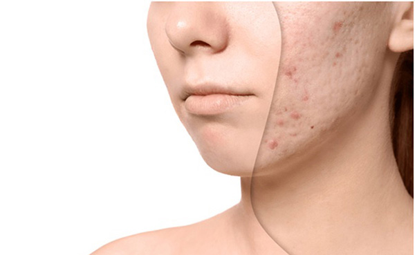 cách trị sẹo mụn