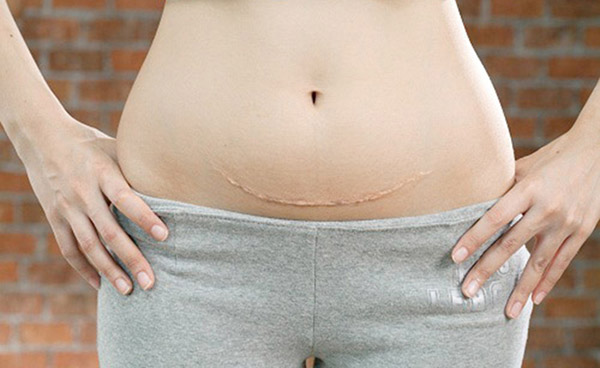 kem trị sẹo vết mổ sau sinh
