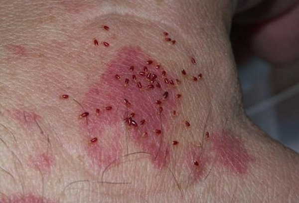 bị côn trùng cắn sưng phù