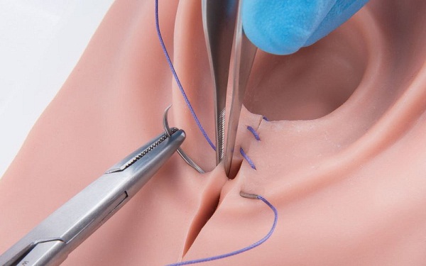Vết khâu tầng sinh môn bị sẹo lồi & Cách khắc phục hiệu quả! 1
