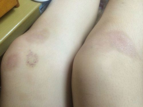xóa sẹo thâm ở chân bằng laser