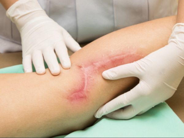 trị thâm chân bằng laser bao nhiêu tiền