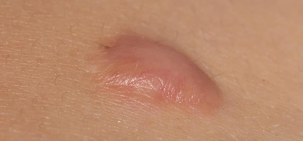 sẹo lồi bị ngứa