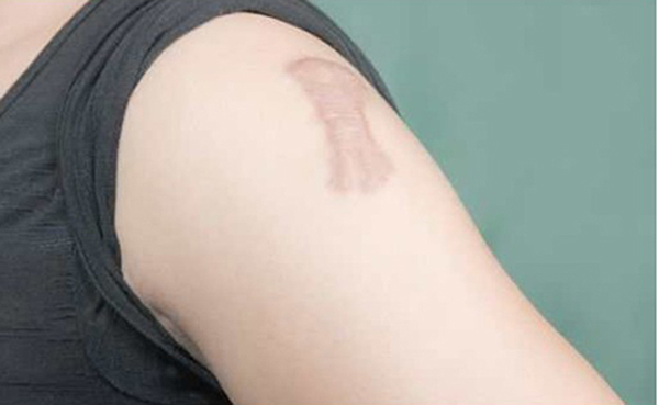 trị sẹo lồi hiệu quả
