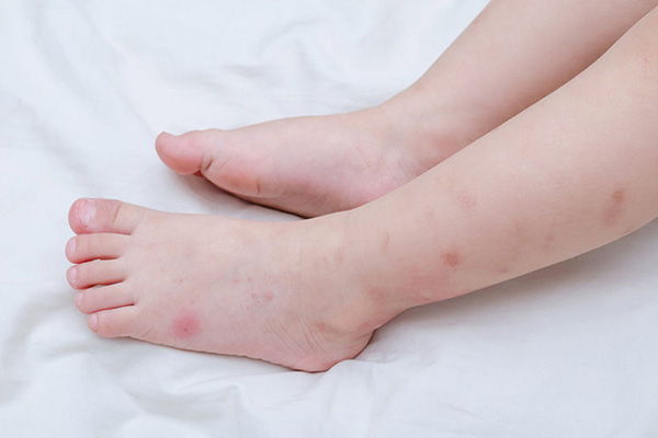 Các vết muỗi đốt rất dễ để lại sẹo nhất là đối với trẻ em.