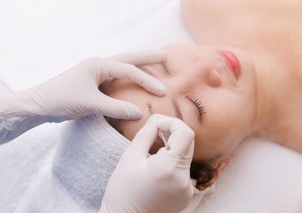mụn trứng cá có nên nặn không