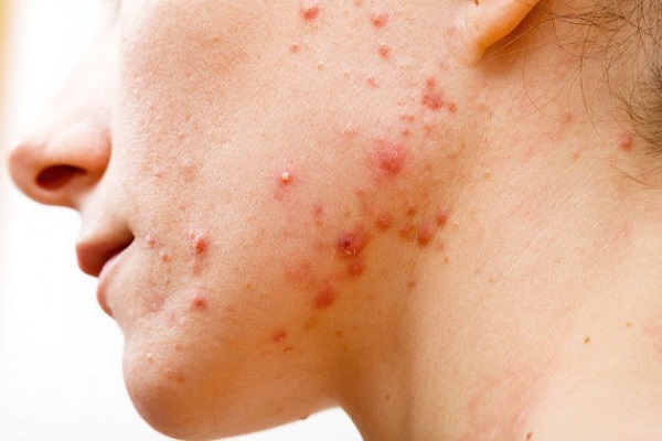 cách nặn mụn không để lại sẹo và thâm