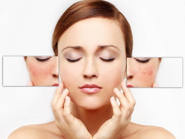 cách nặn mụn không để lại sẹo và thâm