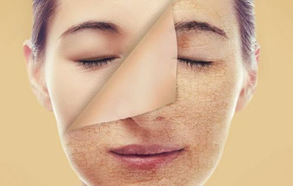 có kinh nặn mụn được không