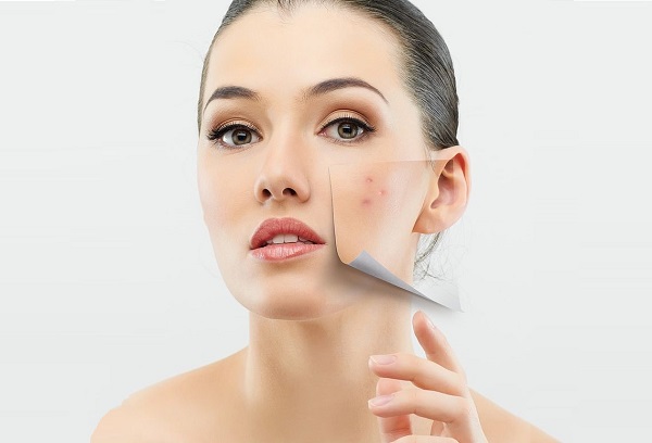 có nên nặn mụn khi có kinh nguyệt