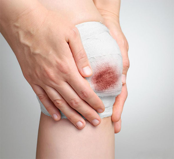 vết bỏng chảy nước vàng