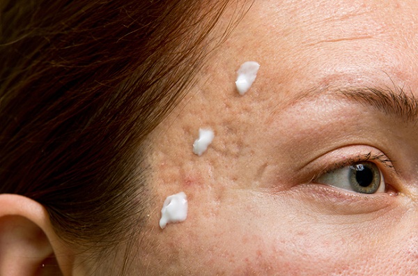 Kem trị sẹo scar esthetique có trị được mụn không 1