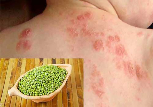 trị giời leo bằng đậu xanh