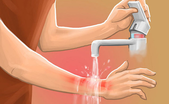 Cách trị bỏng bằng dầu mù u