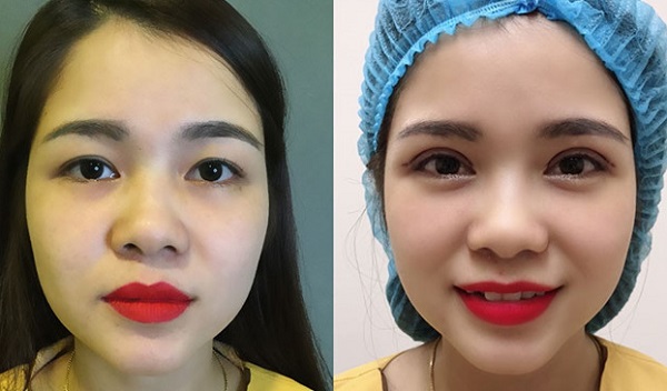 cắt mí bao lâu thì hết sẹo