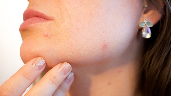 bệnh thủy đậu ở người lớn
