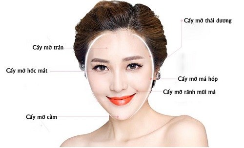 cấy mỡ thái dương được bao lâu