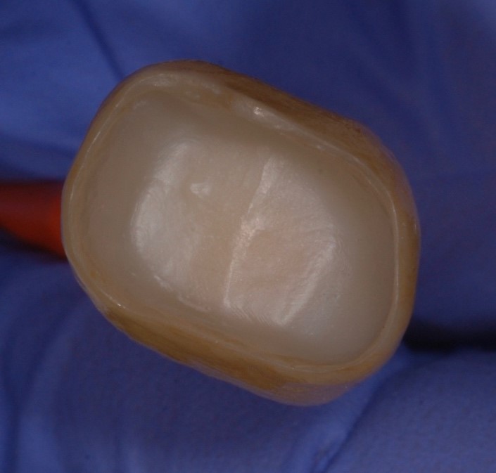 Dental Crown Fell Out? Here's What to Do When You Can't Reach a Dentist