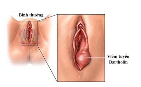 Vùng kín nổi hạch do u nang Bartholin