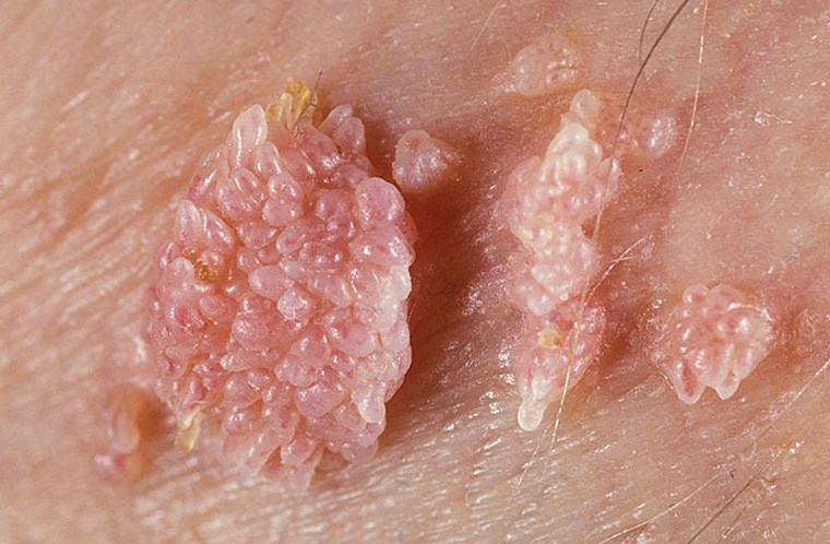Vùng kín nổi hạch do bị sùi mào gà