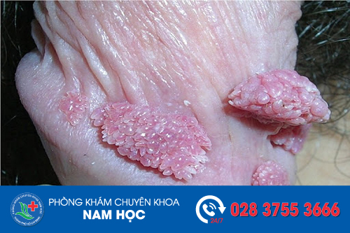 Ẳn gì trị sùi mào gà