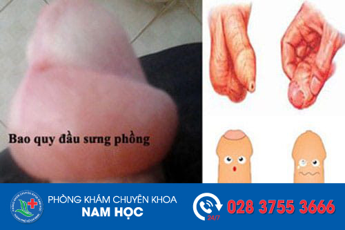 Da bao quy đầu bị sưng phồng