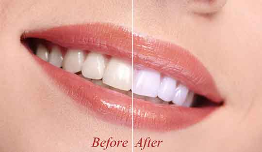 Teeth whitening at your Winter Park, FL Dentist in Orlando