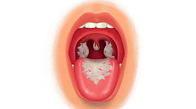 Bệnh bạch hầu là gì? Dấu hiệu và cách phòng tránh