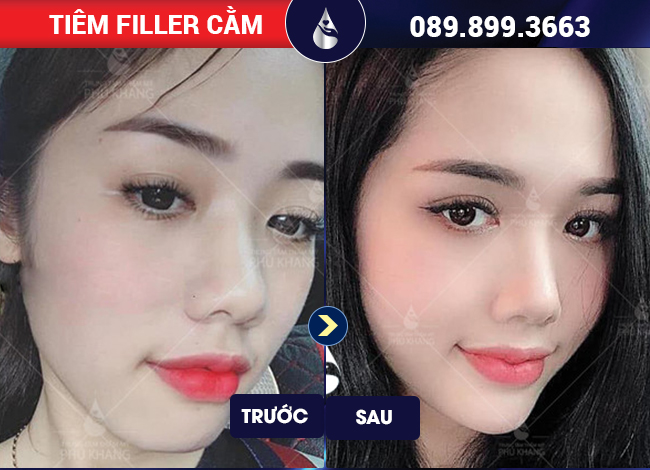 tiêm filler cằm giá bao nhiêu