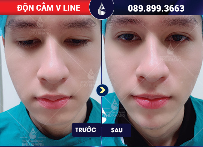 tiêm filler cằm V line