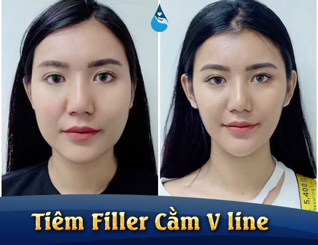 tiêm filler cằm bao nhiêu tiền