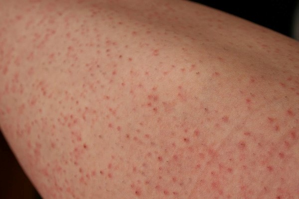 vung-kin-bi-dau-nhu-kim-cham