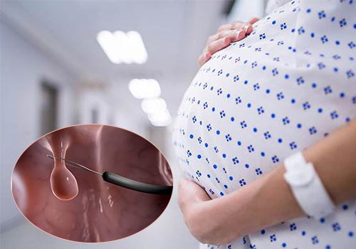 mo-polyp-co-tu-cung-thi-bao-lau-mang-thai-duoc