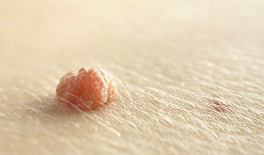 hinh-anh-noi-mun-o-vung-kin-nu-gioi-la-benh-gi