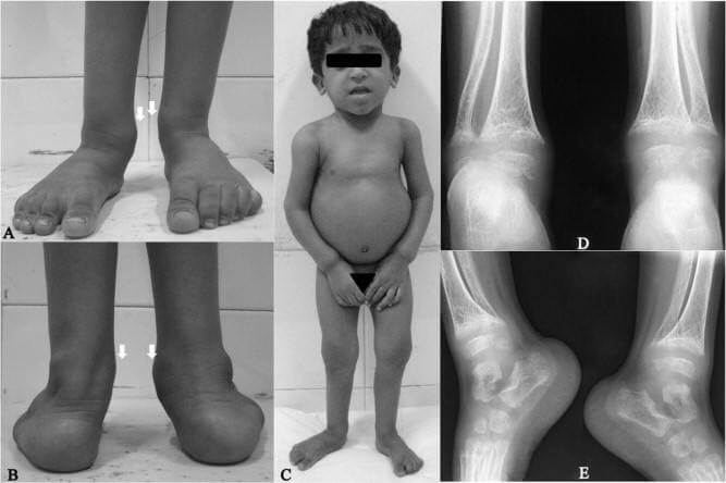 Trẻ thiếu vitamin D dễ bị còi xương, chậm lớn và biến dạng xương