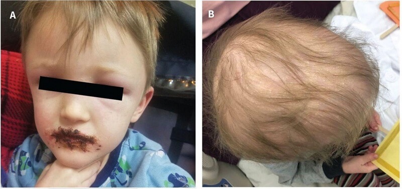 Da vàng, khô, tóc rụng, môi bong tróc, dễ chảy máu là dấu hiệu nhận biết ngộ độc mạn tính vitamin A