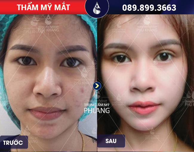 cắt mí bao lâu hết sưng