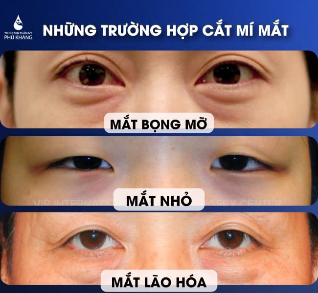 cắt mí mini deep giữ được bao lâu