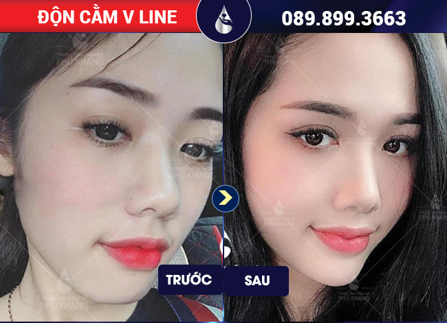 tiêm filler cằm V line