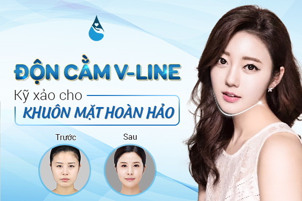 độn cằm V line
