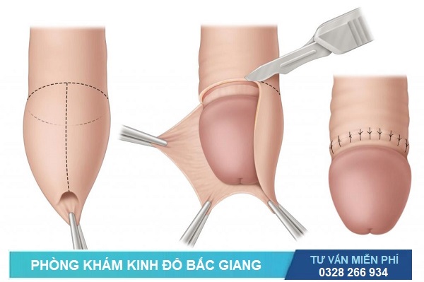 Cắt bao quy đầu ở Yên Thế Bắc Giang