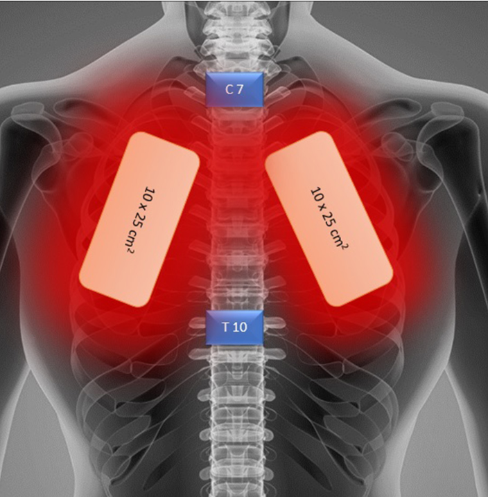 Orientation of the laser beams during laser treatment while in the prone position. The apex of the lung lies above the first