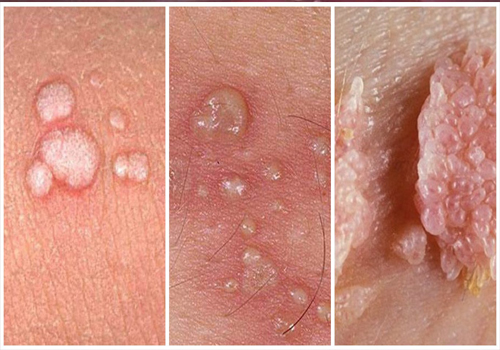 Dấu hiệu sùi mào gà