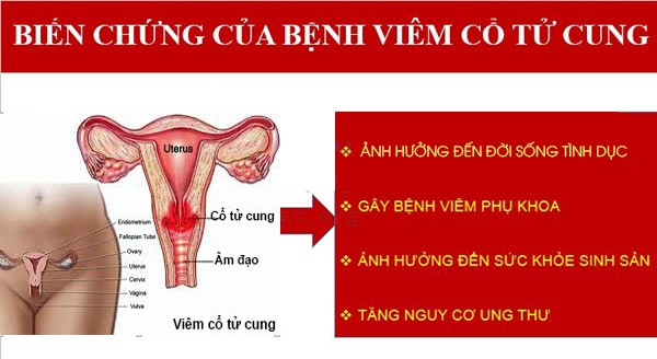 Biến chứng viêm cổ tử cung mãn tính