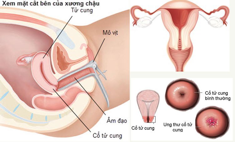 giải phẫu viêm cổ tử cung