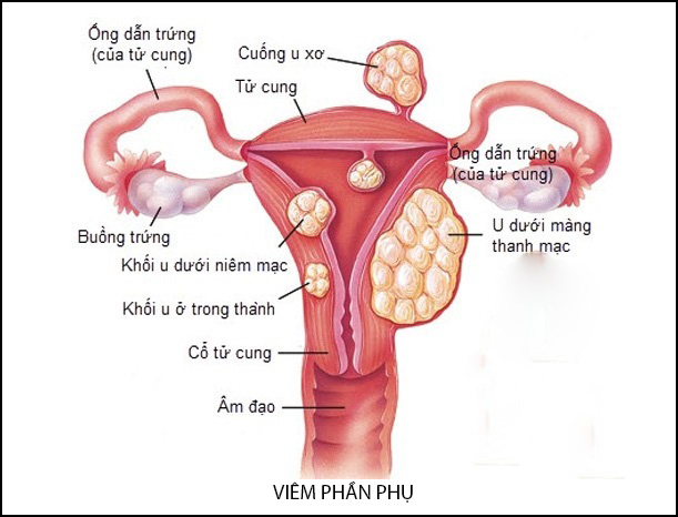 Biến chứng nguy hiểm của viêm phần phụ