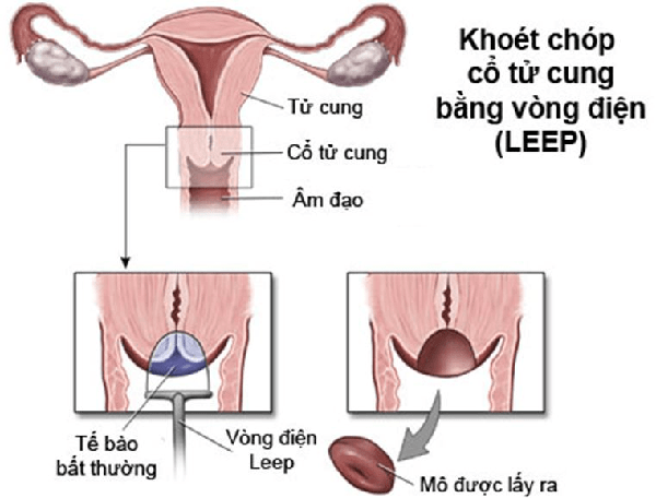 Chữa viêm lộ tuyến cổ tử cung bằng dao LEEP