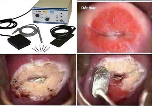 Chi phí đốt viêm lộ tuyến cổ tử cung