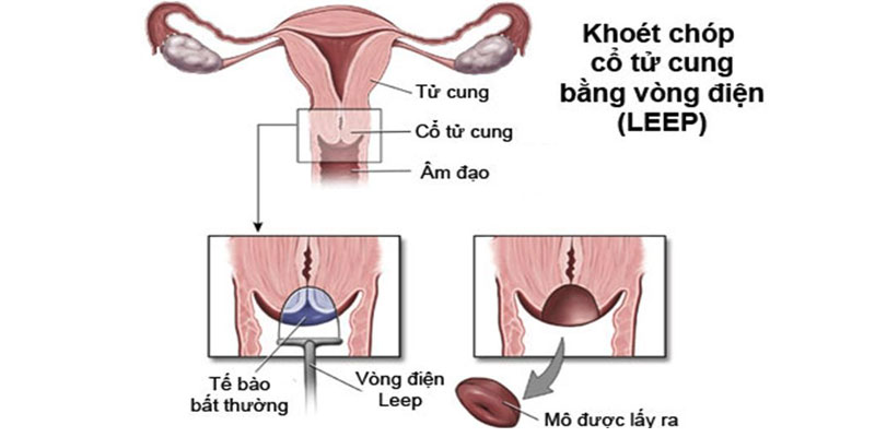 Viêm lộ tuyến cổ tử cung cấp độ 1, 2, 3, 4